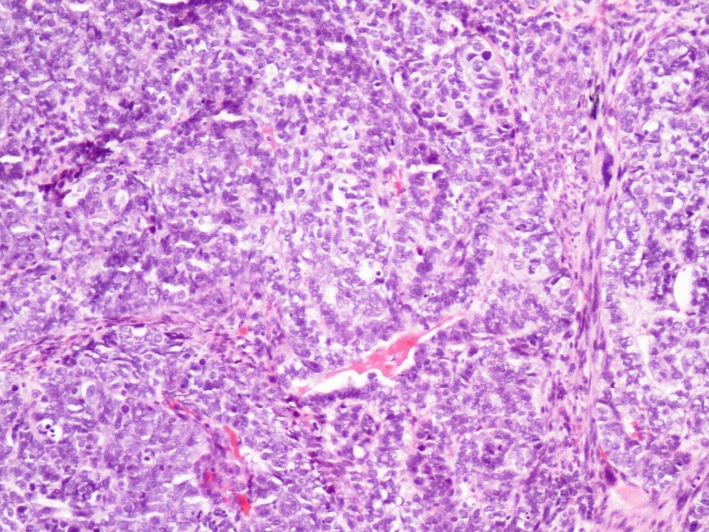 Picture of cervical adenocarcinoma